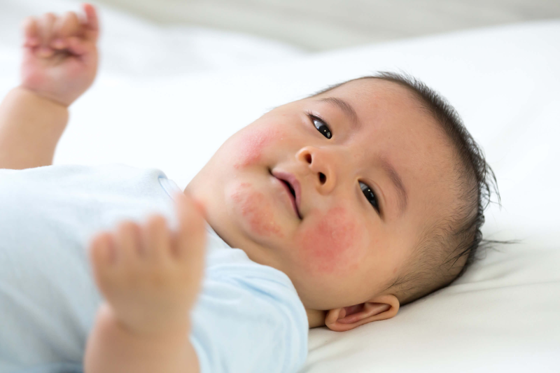 Child showing symptoms of a food allergy, holding a swollen face with worried parents nearby